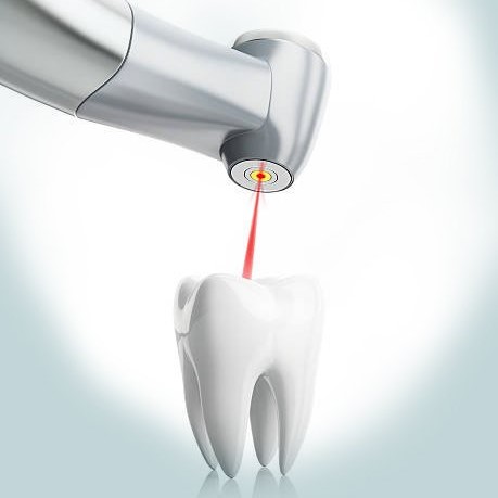 Dental Lasers